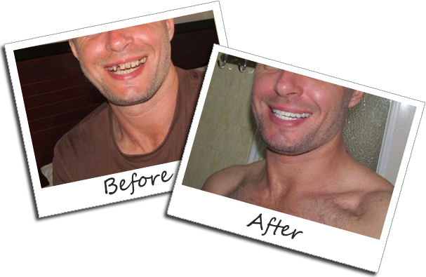 Before and after cosmetic dentistry smile transformation at Lina Dental Clinic Ho Chi Minh City